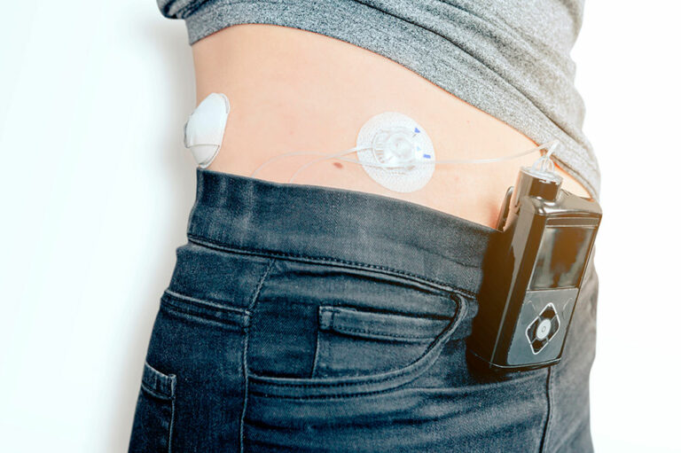 Insulin pumps – 3 best devices to buy in 2021